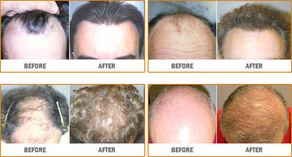 neograft-before-and-afters