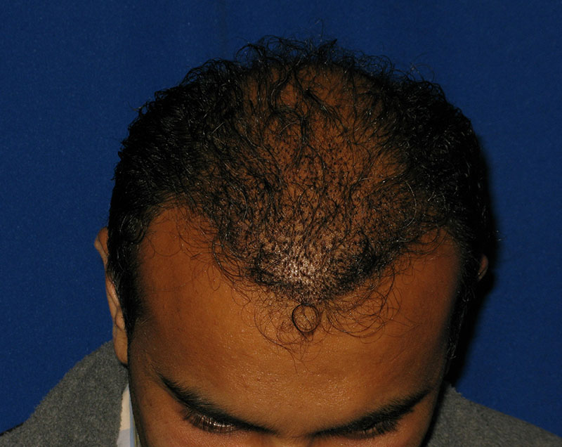 NeoGraft before and after from Dr. Rivela The Woodlands
