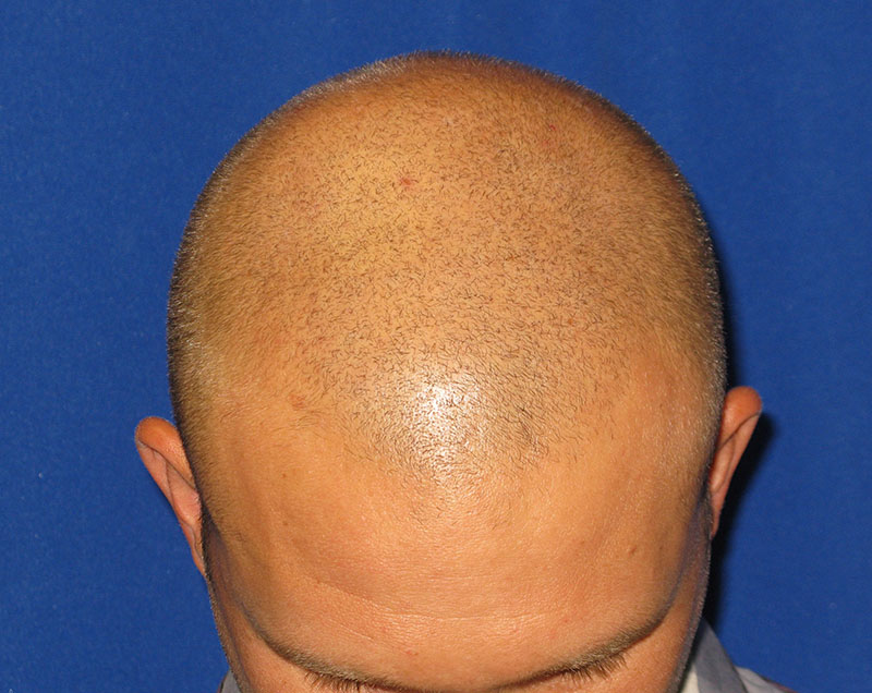 NeoGraft antes y después del Dr. Rivela The Woodlands