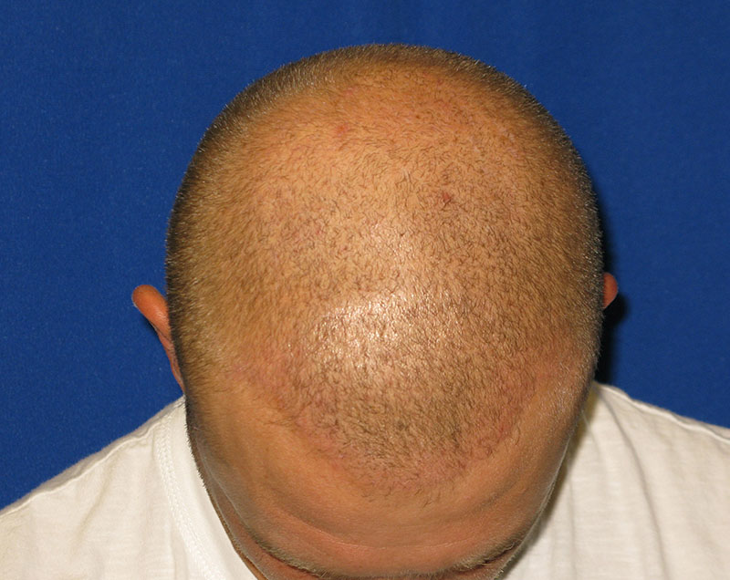 NeoGraft antes y después del Dr. Rivela The Woodlands