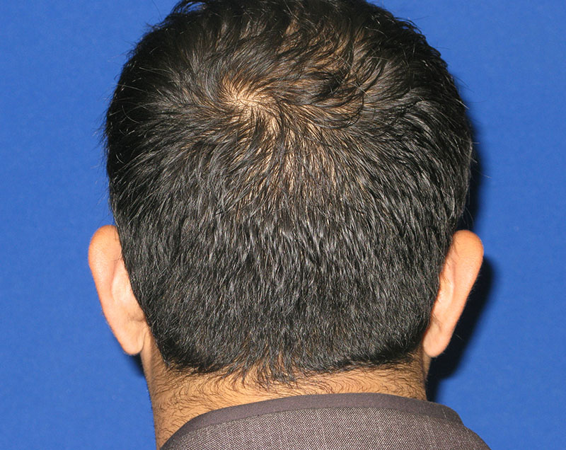 NeoGraft antes y después del Dr. Rivela The Woodlands