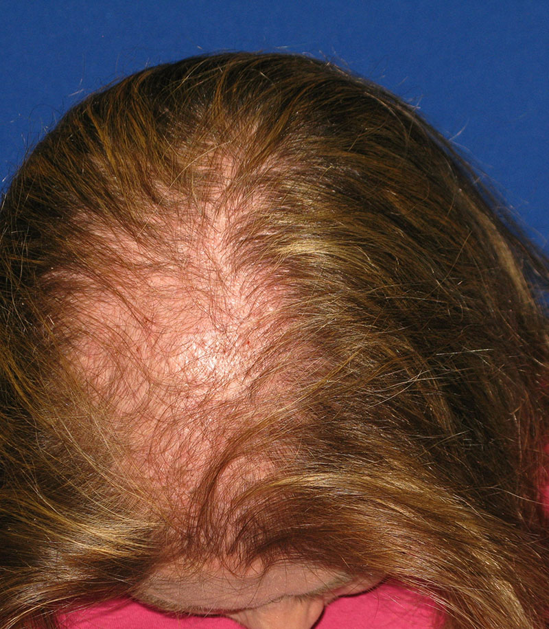 NeoGraft antes y después del Dr. Rivela The Woodlands