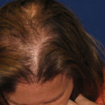 NeoGraft antes y después del Dr. Rivela The Woodlands