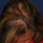 NeoGraft antes y después del Dr. Rivela The Woodlands