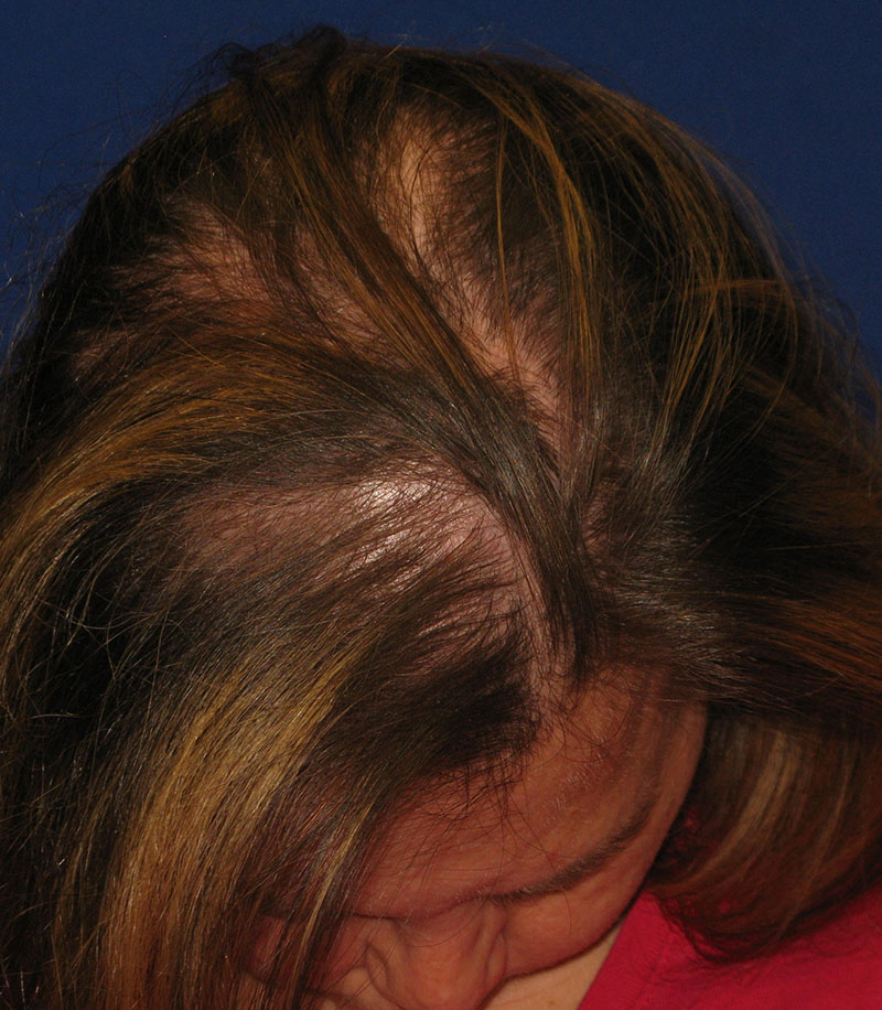 NeoGraft antes y después del Dr. Rivela The Woodlands