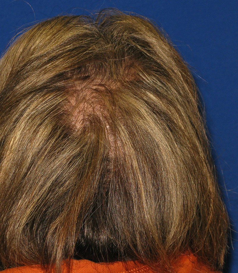 NeoGraft antes y después del Dr. Rivela The Woodlands