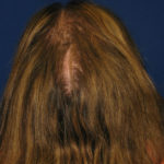 NeoGraft antes y después del Dr. Rivela The Woodlands