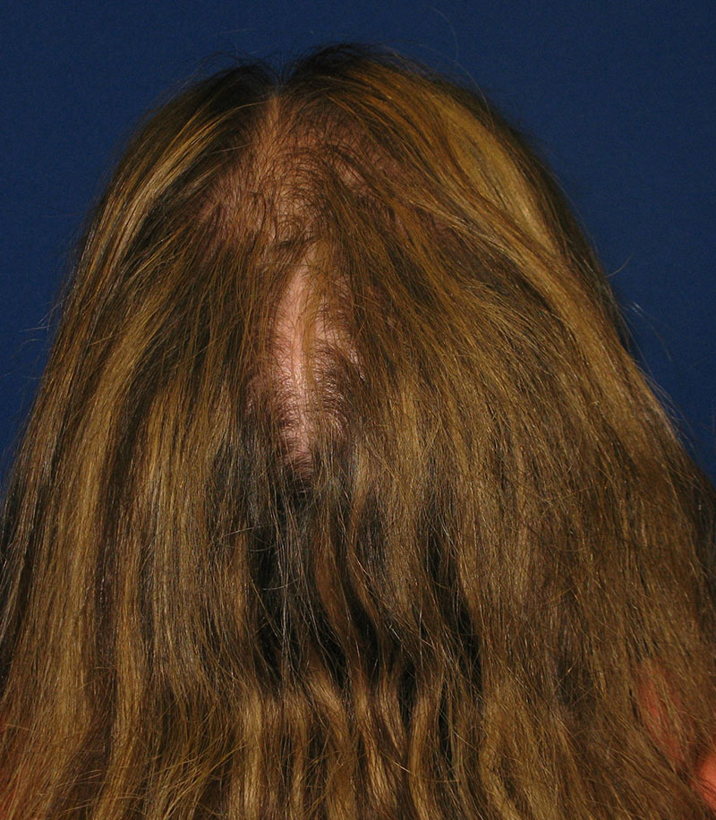 NeoGraft antes y después del Dr. Rivela The Woodlands