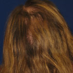 NeoGraft antes y después del Dr. Rivela The Woodlands