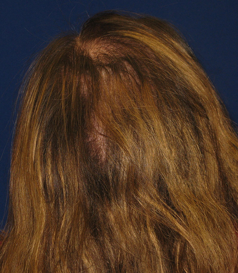 NeoGraft antes y después del Dr. Rivela The Woodlands