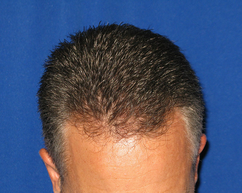 NeoGraft before and after from Dr. Rivela The Woodlands