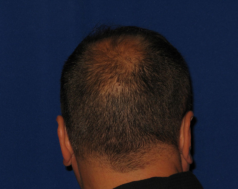 NeoGraft antes y después del Dr. Rivela The Woodlands