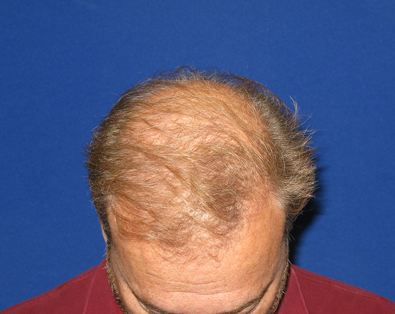 NeoGraft antes y después del Dr. Rivela The Woodlands