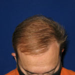 NeoGraft antes y después del Dr. Rivela The Woodlands