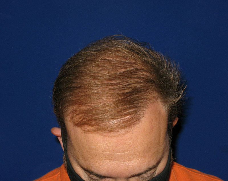 NeoGraft antes y después del Dr. Rivela The Woodlands