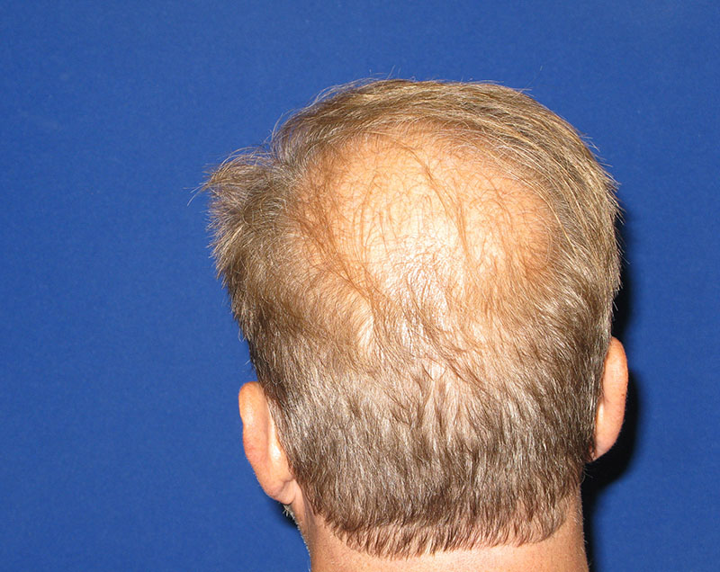 NeoGraft antes y después del Dr. Rivela The Woodlands