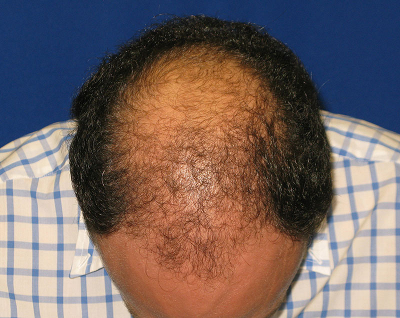 NeoGraft before and after from Dr. Rivela The Woodlands