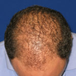 NeoGraft before and after from Dr. Rivela The Woodlands