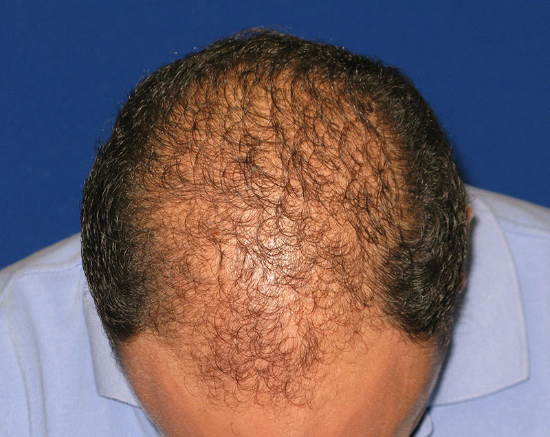 NeoGraft before and after from Dr. Rivela The Woodlands