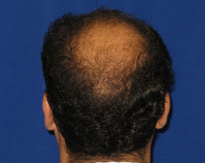 NeoGraft before and after from Dr. Rivela The Woodlands