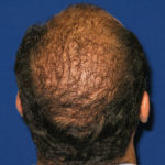NeoGraft before and after from Dr. Rivela The Woodlands