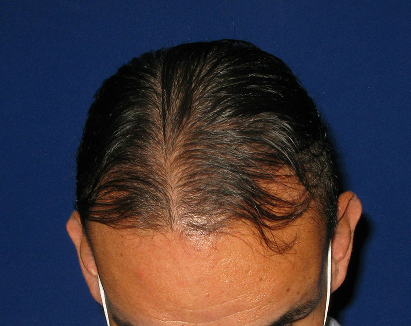 NeoGraft before and after from Dr. Rivela The Woodlands