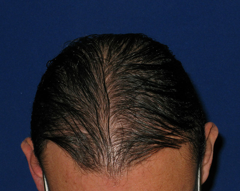 NeoGraft before and after from Dr. Rivela The Woodlands