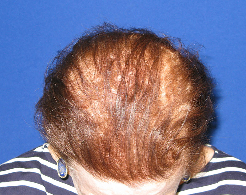 NeoGraft before and after from Dr. Rivela The Woodlands