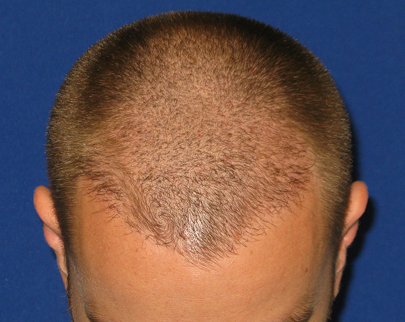 Neograft/Hair Restoration Result Houston