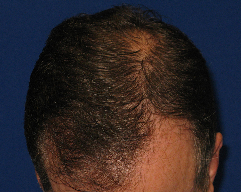 NeoGraft antes y después del Dr. Rivela The Woodlands