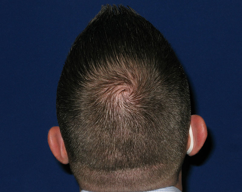 NeoGraft antes y después del Dr. Rivela The Woodlands
