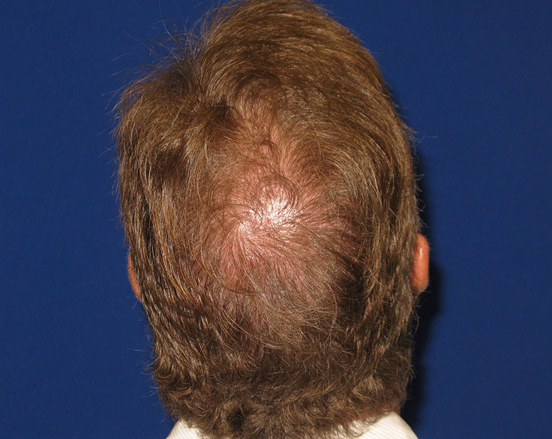 NeoGraft before and after from Dr. Rivela The Woodlands