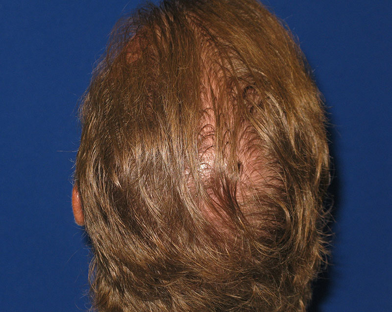 NeoGraft before and after from Dr. Rivela The Woodlands