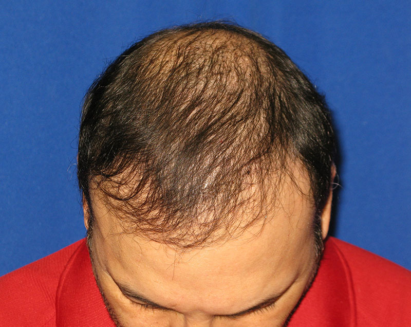 NeoGraft antes y después del Dr. Rivela The Woodlands