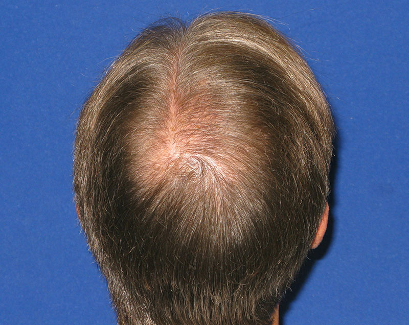 NeoGraft before and after from Dr. Rivela The Woodlands