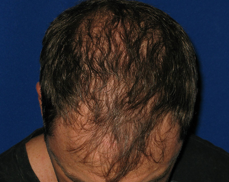 NeoGraft antes y después del Dr. Rivela The Woodlands