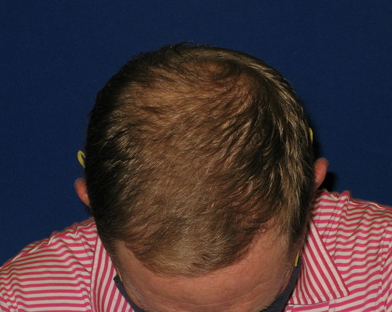 NeoGraft antes y después del Dr. Rivela The Woodlands