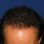 NeoGraft before and after from Dr. Rivela The Woodlands
