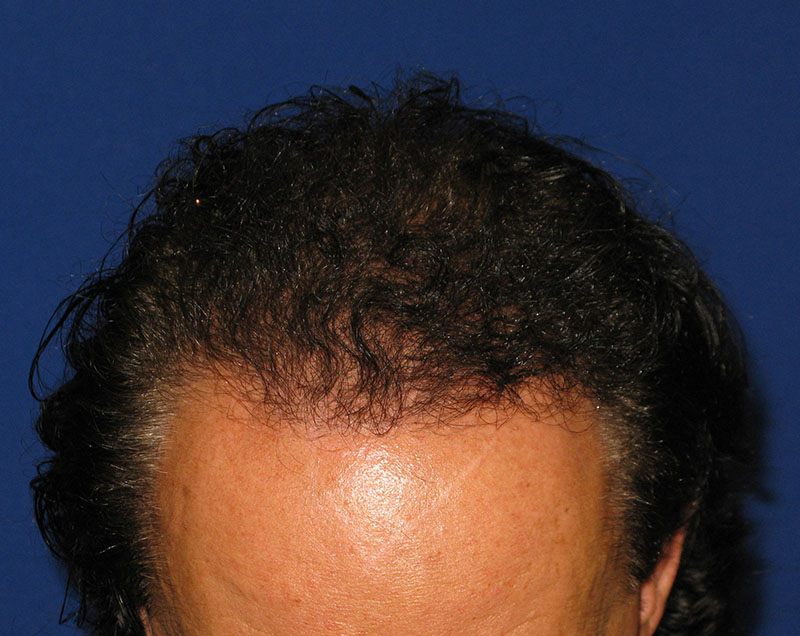 NeoGraft before and after from Dr. Rivela The Woodlands