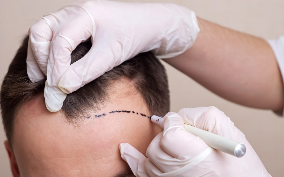 What is Recovery Like After a Hair Transplant?